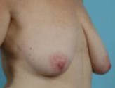 Patient # 16733 Before Photo # 3